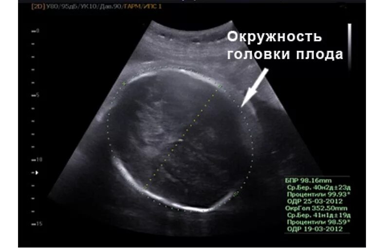 Окружность головы плода. Измерение окружности живота плода УЗИ. Бипариетальный размер головы плода. Бипариетальный размер головки.