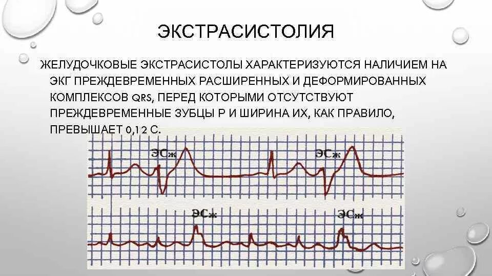 Желудочковая и наджелудочковая экстрасистолия на ЭКГ. Желудочковая экстрасистола на кг. Желудочковая аритмия на ЭКГ. Желудочковая экстрасистолия на ЭКГ расшифровка. Экстрасистолы много