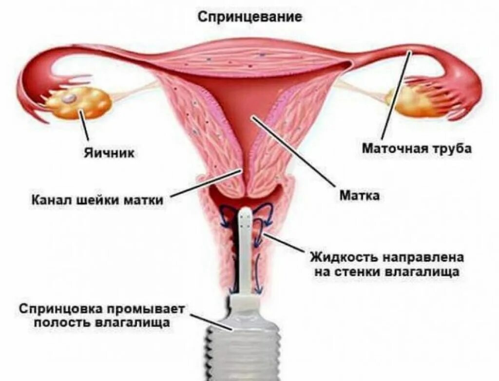 спринцевание влагалища. спринцевание. спринцовка для орошения. спринцовка для орошения вагинальная. спринцевание.