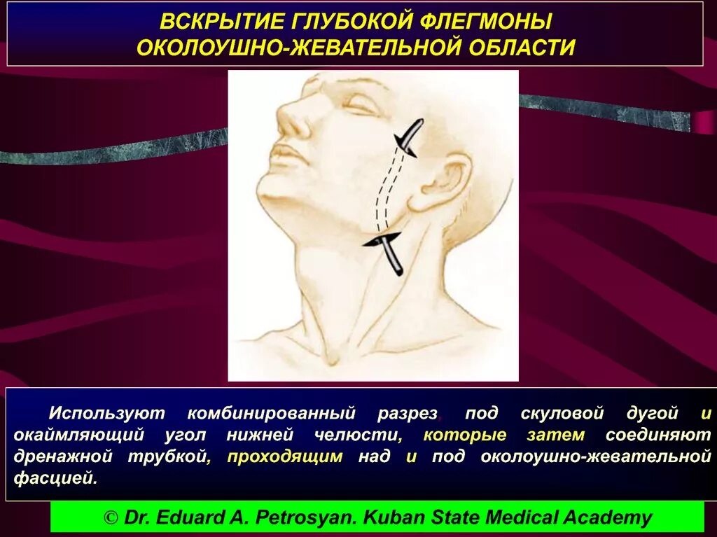 Флегмона околоушно-жевательной области. Абсцесс околоушно-жевательной области. Вскрытие флегмоны околоушно жевательной области. Флемонаоколоушно-жевательной области. Операция абсцесс шеи