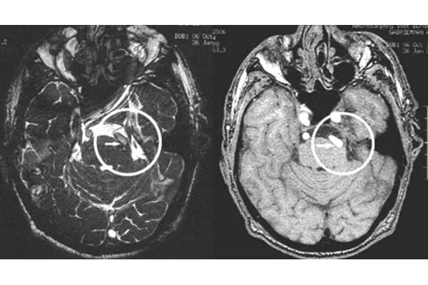 Невралгия тройничного нерва нейроваскулярный конфликт. Нейроваскулярный конфликт мрт невралгия тройничного нерва. Нейроваскулярный конфликт тройничного нерва мрт. Вазоневральный конфликт тройничного нерва мрт.