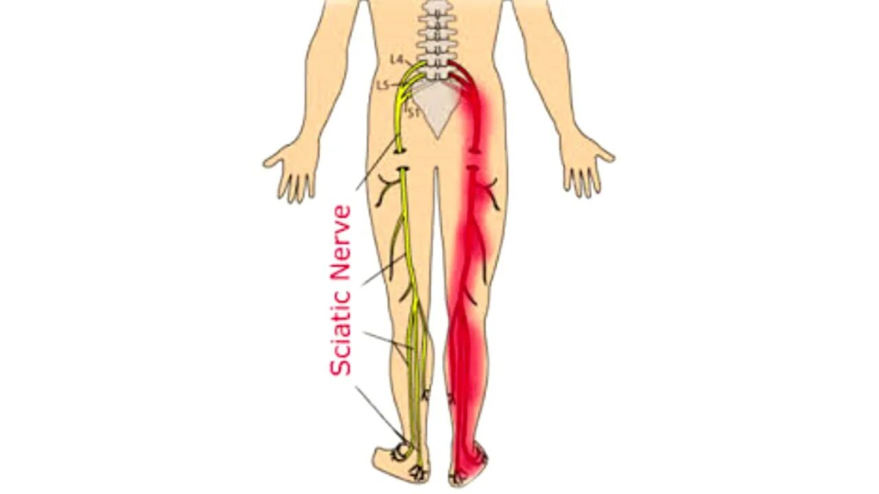 Сильные боли седалищного нерва. Точка выхода седалищного нерва схема. Невропатия седалищного нерва. Седалищный нерв Нейродикловит. Седалищный нерв схема расположения.