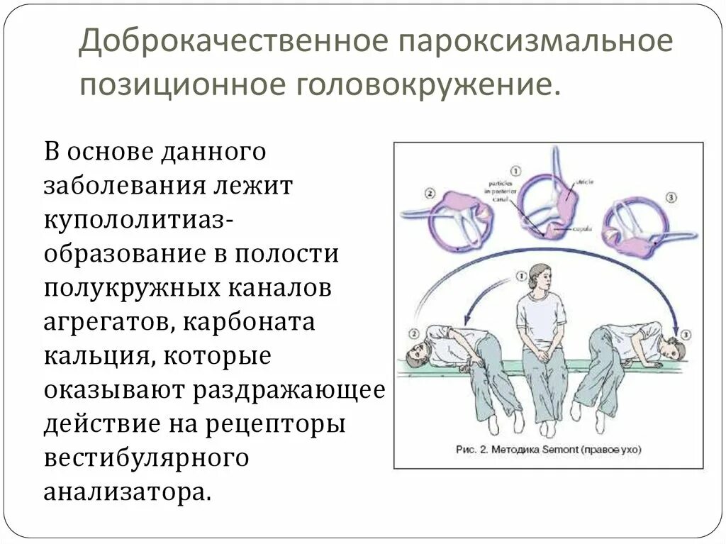 Аппарат вестибулярный нарушения симптомы лечение у взрослых. Доброкачественное пароксизмальное позиционное головокружение. Вестибулярный аппарат ДППГ. Доброкачественное пароксизмальное головокружение диагностика. ДППГ доброкачественное пароксизмальное позиционное.