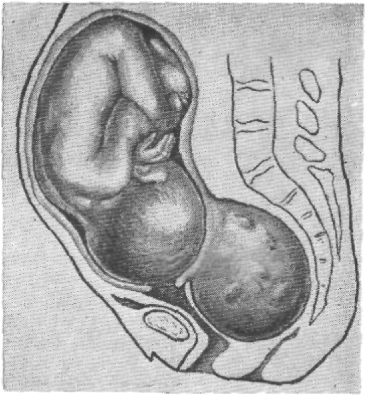 Удлиненная матка при беременности