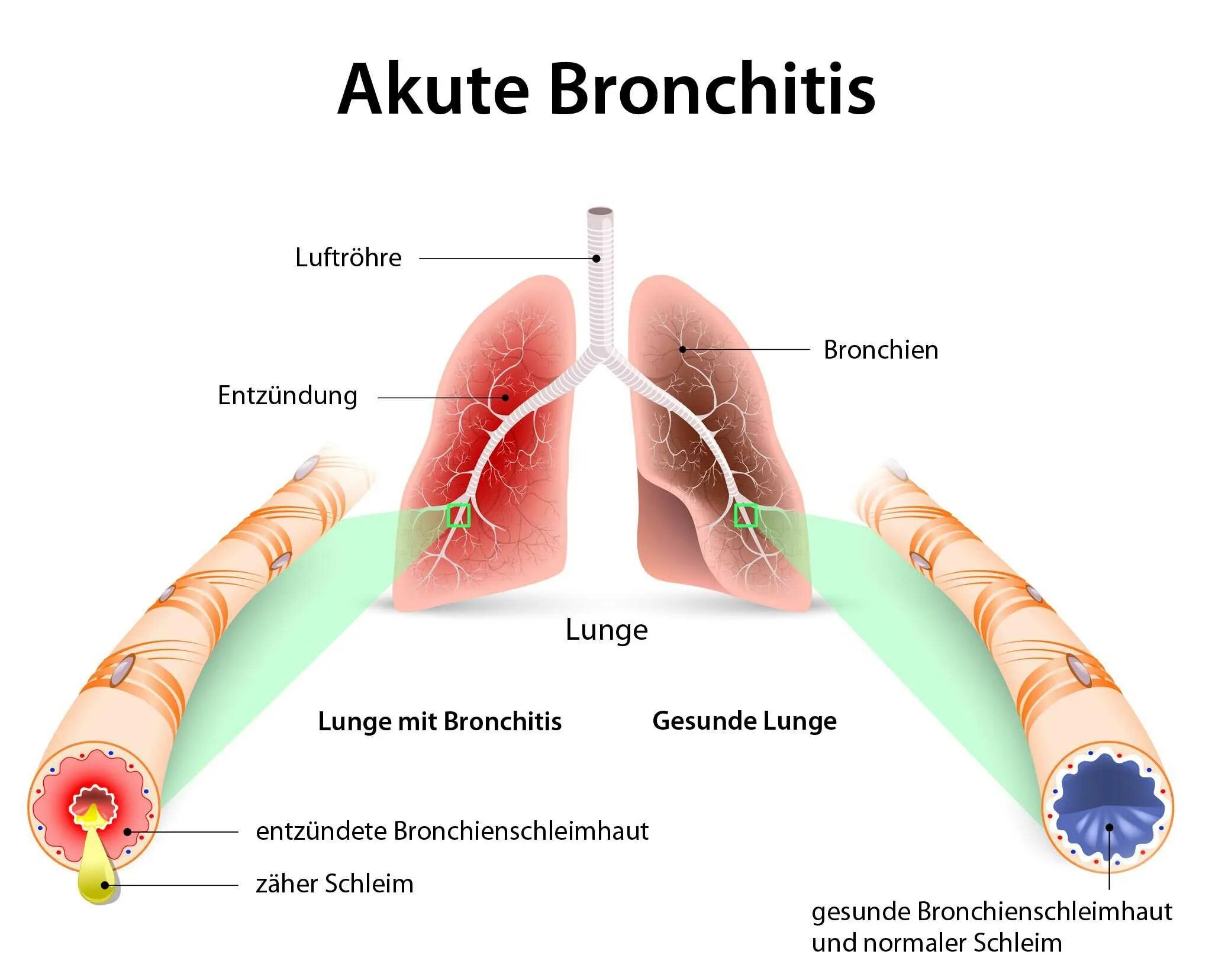 Бронхит бронхи. O'tkir bronxit. Воспаление бронхов – бронхит.