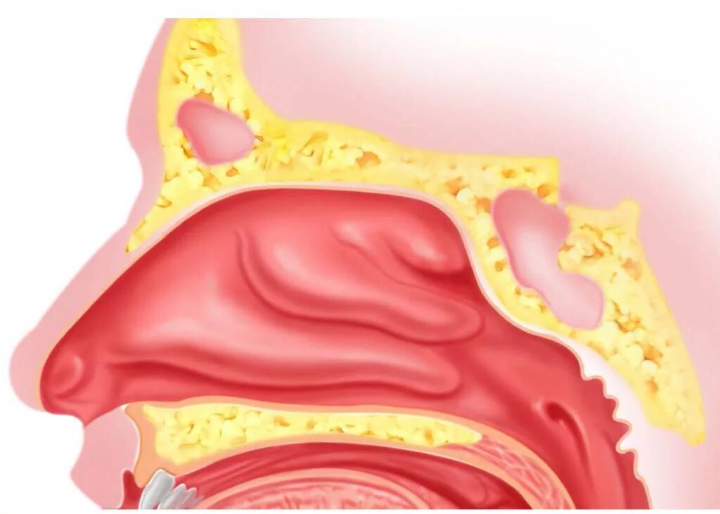 Катаральный насморк. Полость носа. Слизистая носа при аллергии.