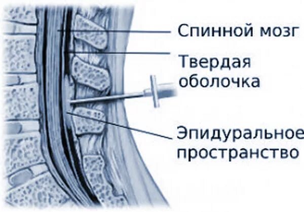 Эпидуральное и субдуральное пространство. Эпидуральное пространство спинного мозга. Дуральный мешок анатомия. Субарахноидальное пространство и эпидуральное пространство.