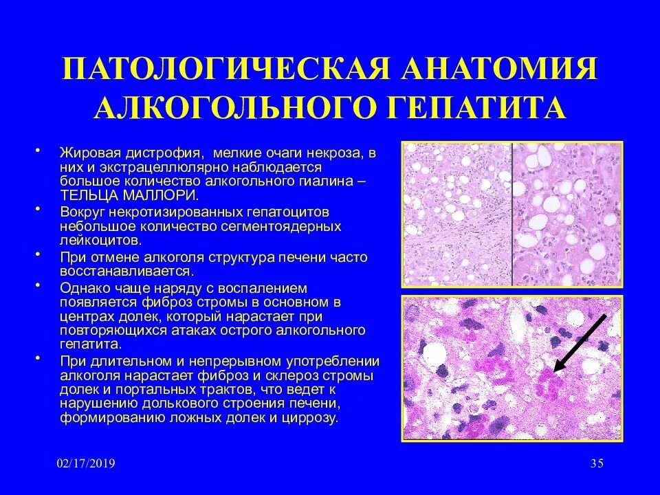 Стеатоз печени гистология. Жировой гепатоз препарат патанатомия. Жировая дистрофия печени патанатомия. Патоморфология жировая дистрофия печени. Алкогольная жировая болезнь