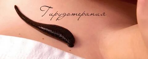 Вам поможет пиявка