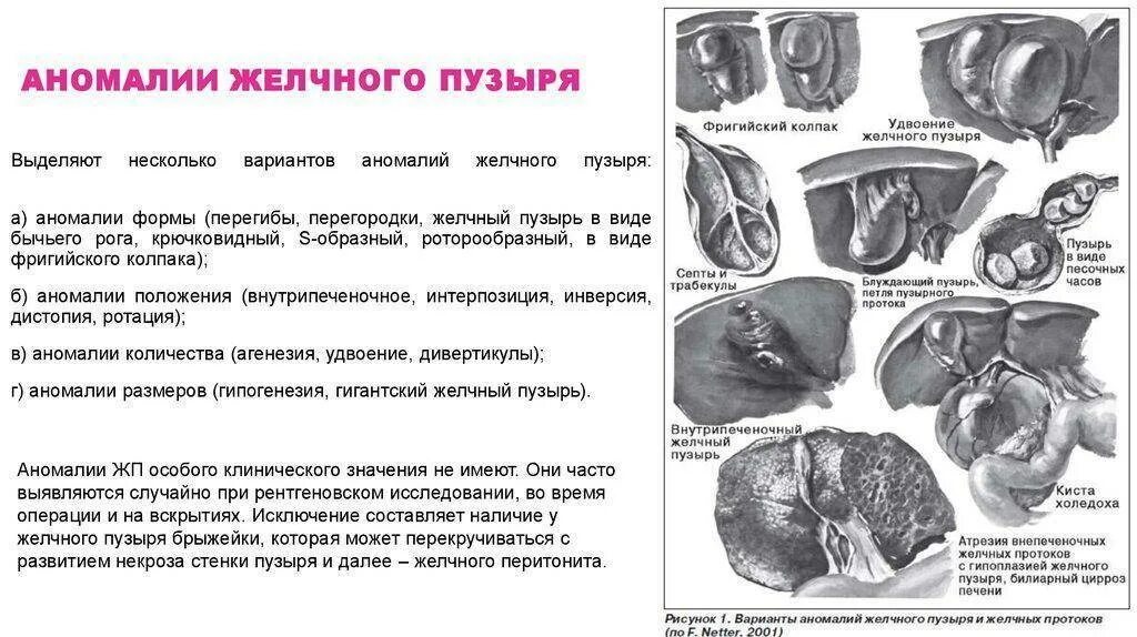 Желчный пузырь гомогенное что значит. Врожденные аномалии желчного пузыря. Врожденные пороки развития желчного пузыря. Аномалия формы желчного пузыря по УЗИ. Врожденная патология желчного пузыря.