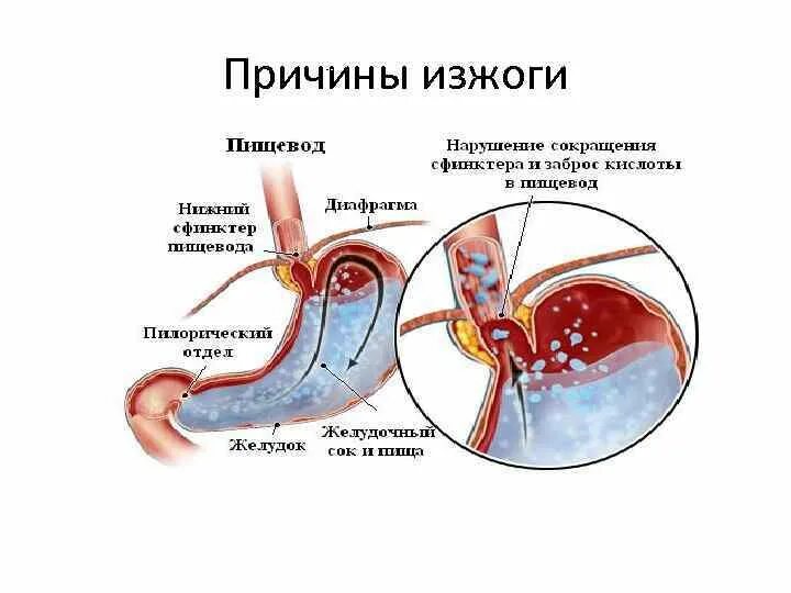 При каких заболевания изжога. Изжога причины. Причины возникновения изжоги.