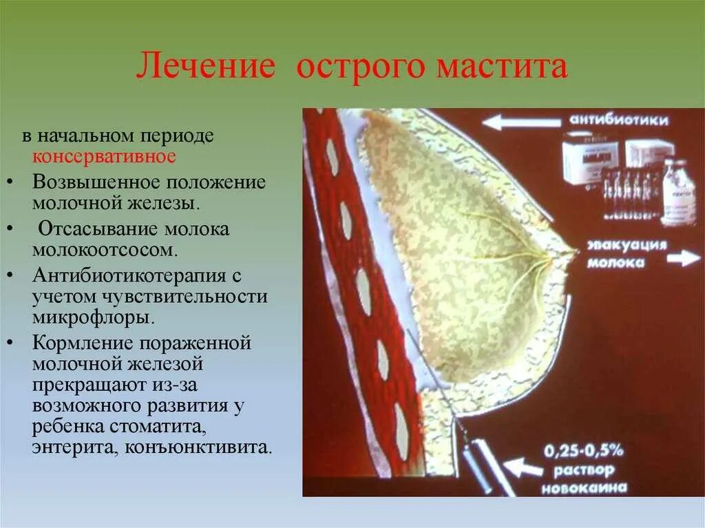 Серозная стадия мастита. Молочные железы мастит.