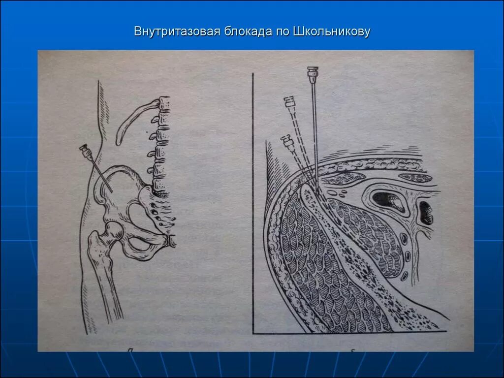 Блокада по Школьникову-Селиванову техника. Новокаиновая блокада по Школьникову. Техника выполнения внутритазовой блокады по Школьникову-Селиванову. Новокаиновая блокада Школьникова Селиванова. Школьникова селиванова