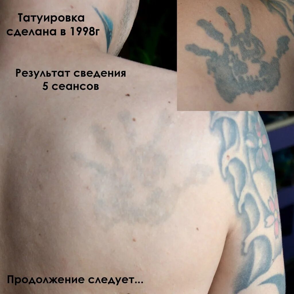 Можно пить после сеанса тату. Сведение татуировок лазером. этапы сведения татуировки лазером.