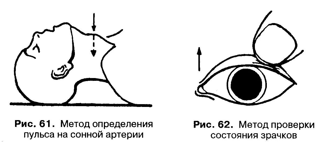 Резкая реакция на свет. Метод определения реакции зрачка на свет. Реакция зрачков на свет у пострадавшего. Реакция зрачков на свет в норме.