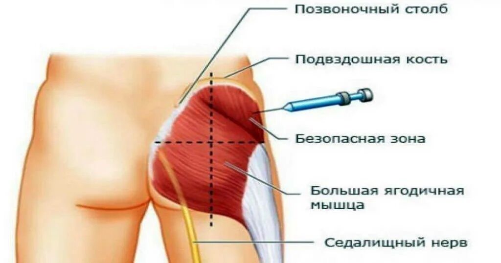 Как правильно ставить укол в мышцу. Как правильно сделать укол в мышцу ягодицы. внутримышечная инъекция верхний квадрант. схема внутримышечных уколов в ягодицу. внутримышечное введение лекарственного препарата в ягодичную мышцу.