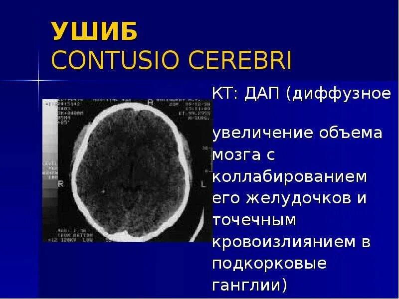 Диффузное аксональное повреждение мозга. Диффузное аксональное поражение. Диффузное аксональное повреждение кт. Диффузно аксональные повреждения головного мозга кт. Диффузная травма головного мозга.