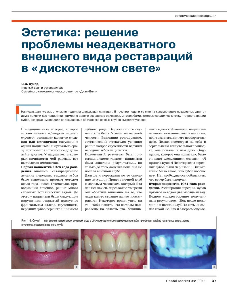 Типы реставраций. Виды реставрации зубов. Современные методики реставрации зубов. Реставрация зуба определение. Эстетическая реставрация зубов.