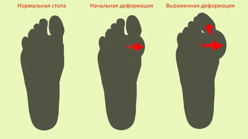 Типы стопы человека. Нормальная стопа. Нормальная стопа человека. Формы стопы ног. Нормальная форма стопы человека.