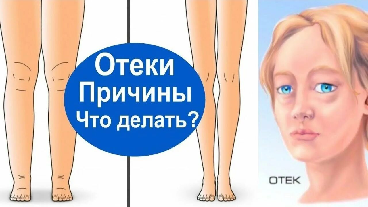 Как уменьшить отечность