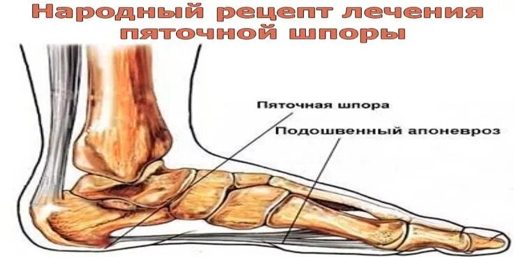 Шпора как лечить форум. Шпора как лечить форум