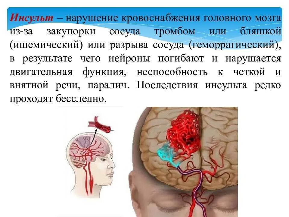 Артерии головного мозга симптомы. Инсульт сосудов головного мозга. Артерии мозга при инсульте.