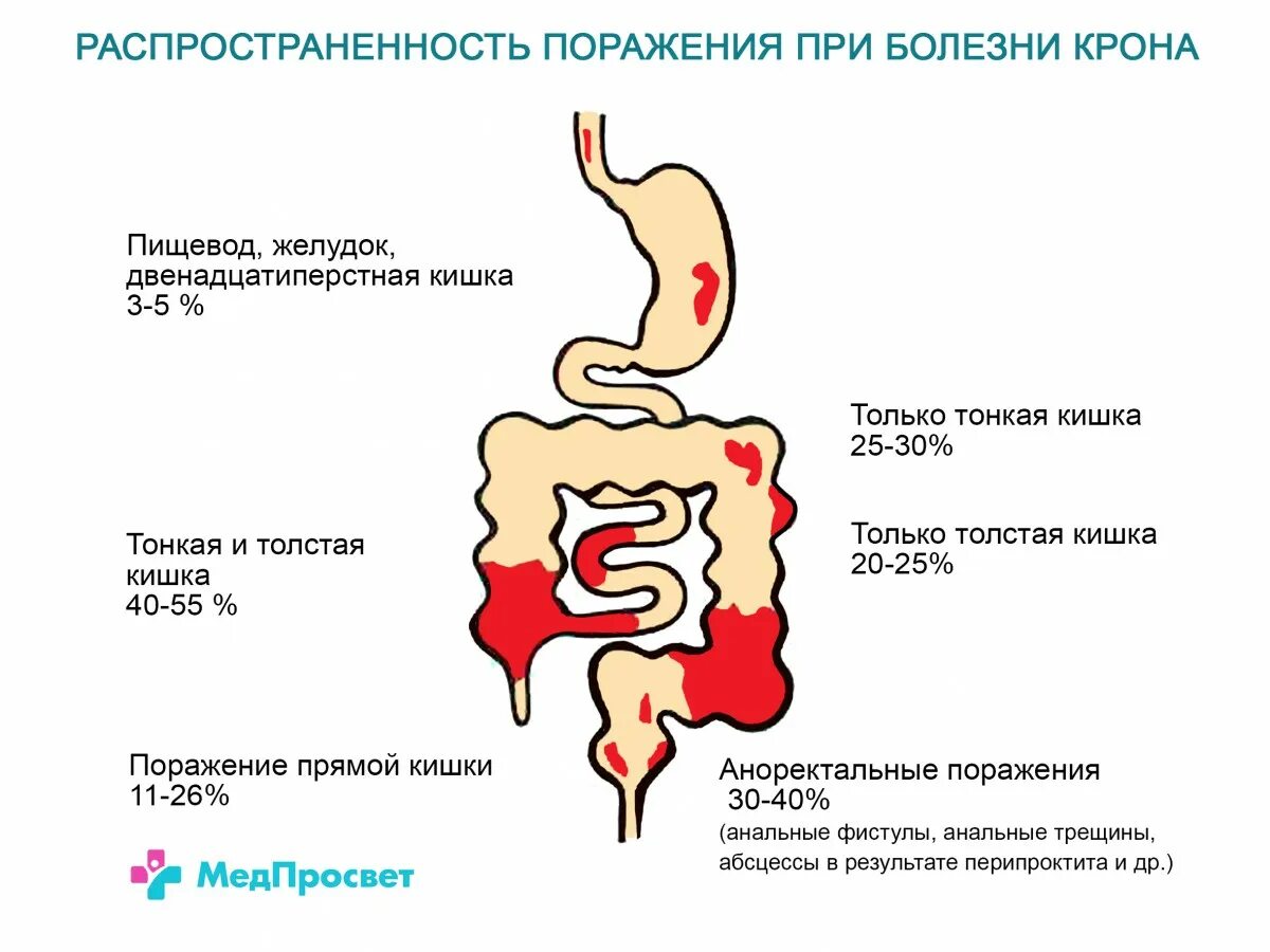 Болезнь крона как живете. Болезнь крона терминальный илеит. Болезнь крона кишечник. Кишечник при болезни крона. Воспаление при болезни крона.