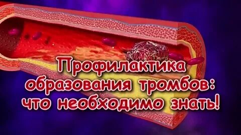 Что нужно чтобы не образовывались тромбы