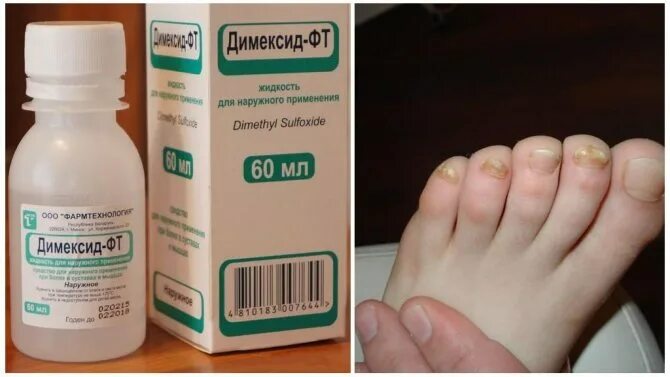 средства от ногтевого грибка лучшие. лак от грибка ногтей. самое эффективное средство от грибка ногтей на ногах. препараты от грибка ногтей. лекарство от запущенного грибка ногтей.