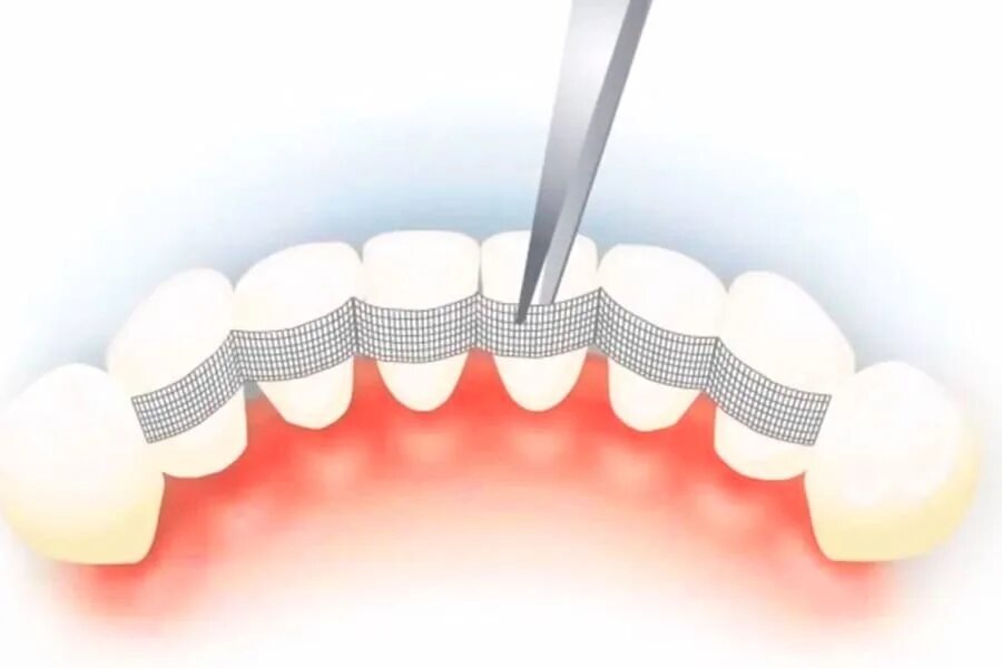 Имплантаты neodent. Протезирование вао. Протез бедра модульный цито. Имплант nobel parallel. Протезирование вао.