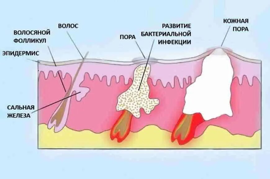 Почему появляются воспаления. Инфильтрация фурункула.