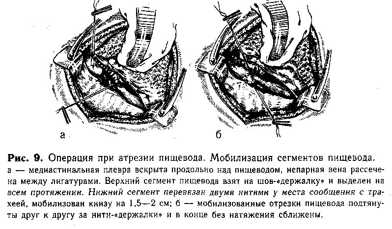 Атрезия пищевода хирургия. Операции при атрезии пищевода прямой анастомоз. Атрезия пищевода этиопатогенез. Операции при атрезии пищевода. Слепой пищевод