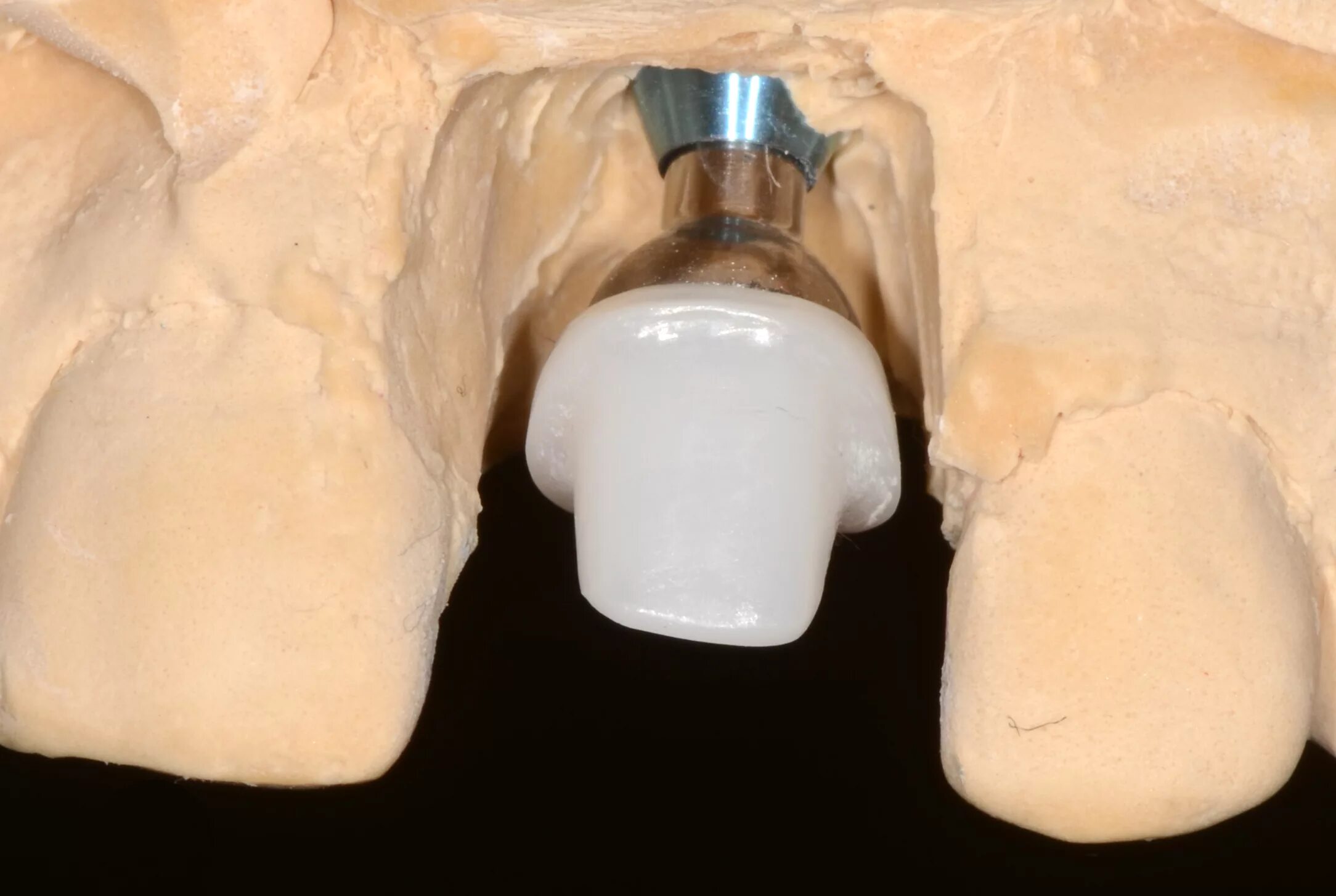 индивидуальный циркониевый абатмент. абатмент из диоксида циркония. абатмент для циркониевой коронки. абатмент zirconia nobel. абатмент из диоксида циркония.