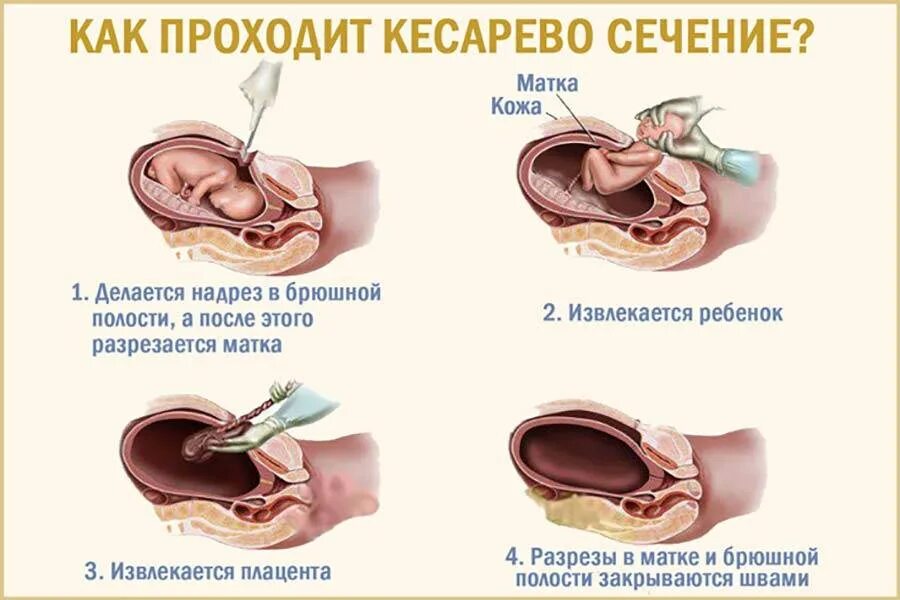 Кесарево когда можно беременеть. Как делают кесоровасечение. Кесаревое Сечени.