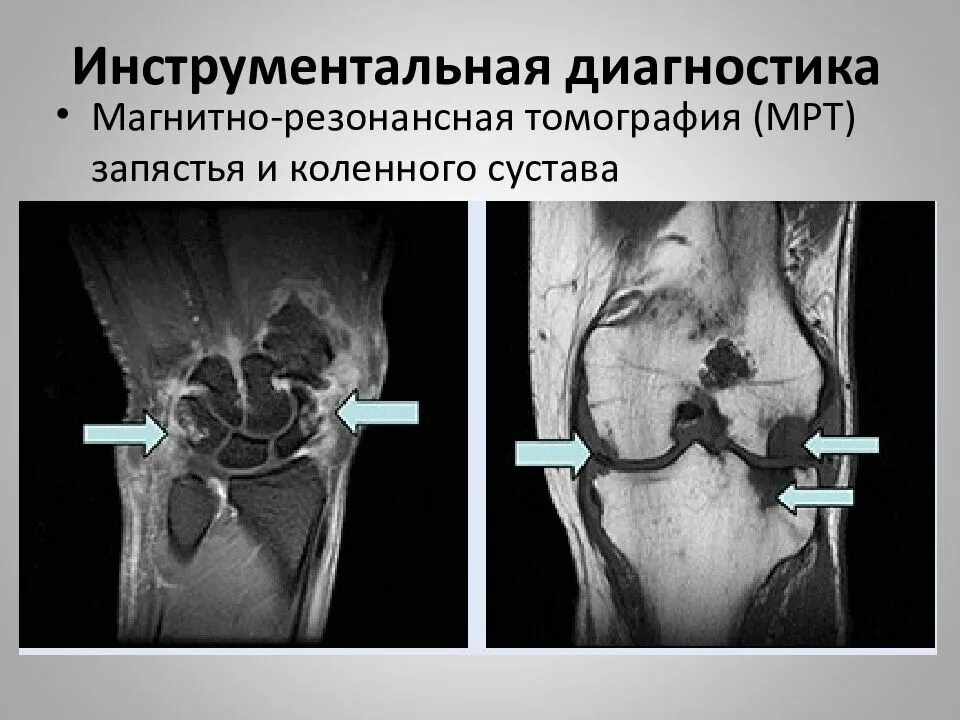 Мрт при боли в суставах. Псориатический артрит коленного сустава мрт. ревматоидный артрит коленного сустава кт. ревматоидный артрит коленного сустава мрт. ревматоидный артрит коленного сустава паннус мрт.
