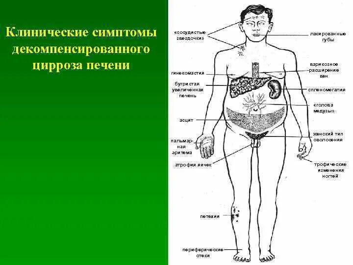 Цирроз первые признаки у женщин. Клинические проявления цирроза печени. Опорные клинические признаки цирроза печени. Клинические проявления при циррозе печени. Ранние признаки цирроза печени.