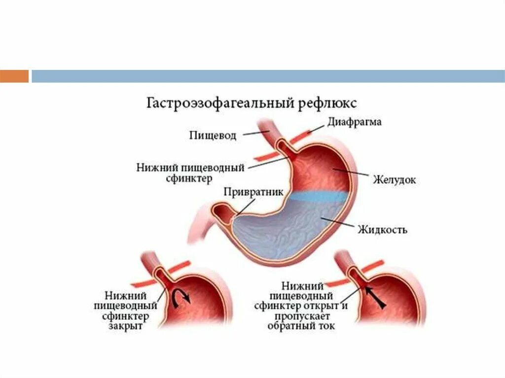 Рефлюкс диафрагмы. Нижний пищеводный сфинктер. Недостаточность Нижнего пищеводного сфинктера. Желудочно-пищеводный рефлюкс пищевод.