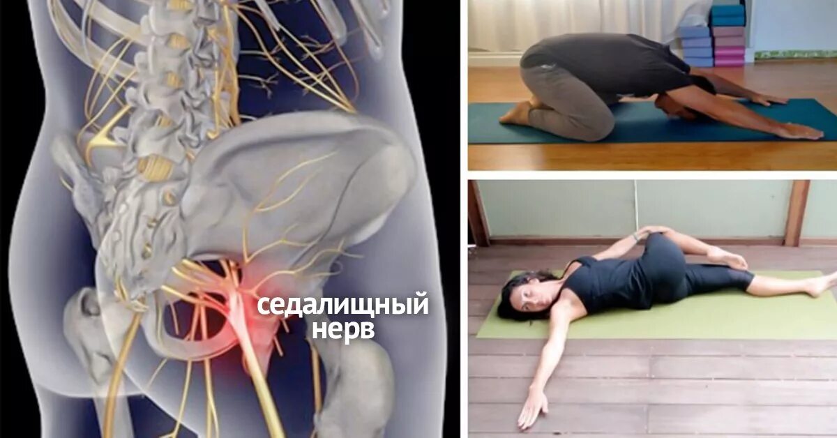 Что происходит при защемлении седалищного нерва. Защемление седалищного нерва гимнастика. гимнастика для седалищного для для защемление. защемление седалищного нерва при беременности гимнастика. гимнастика при защемлении седалищного нерва по бубновскому.