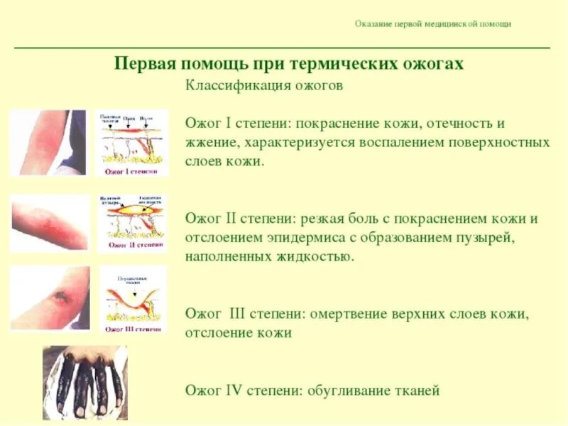 Ожог 2 степени алгоритм. Оказание 1 медицинской помощи при термических ожогах. пмп при термическом ожоге 1 степени. пмп при термическом ожоге 2 степени. пмп при термических ожогах 1 и 2 степени.
