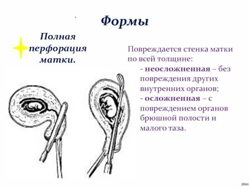 Какая матка при воспалении. Перфорация стенки матки при аборте. Перфорация (прободение) стенки матки. Перфорация ВМС В стенку матки. Перфорация матки при выскабливании.