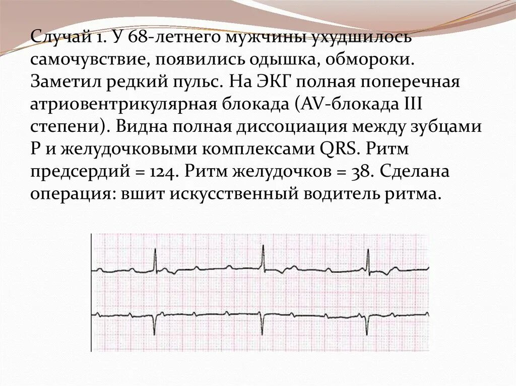 Что значит полная блокада. АВ блокады классификация на ЭКГ. Поперечная блокада 1 степени на ЭКГ. Пульс при АВ блокаде 1 степени. Полная поперечная блокада сердца ЭКГ.