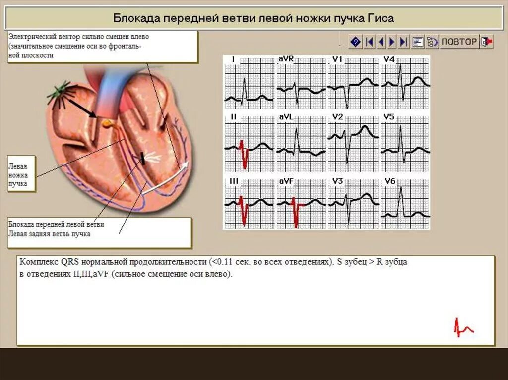 Блокада пучка гиса на экг у ребенка. Блокады ветвей пучка Гиса на ЭКГ. Блокада ЛНПГ на ЭКГ. Блокада ПНПГ И передней ветви ЛНПГ на ЭКГ. Блокада передней ветви ЛНПГ на ЭКГ.