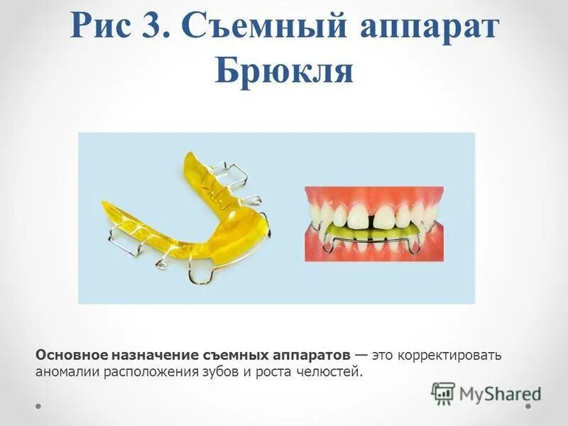 каппа катца. лечебной накусочной пластинке с наклонной плоскостью. я. аппарат брюкля с наклонной плоскостью. аппарат брюкля рейхенбаха в ортодонтии.