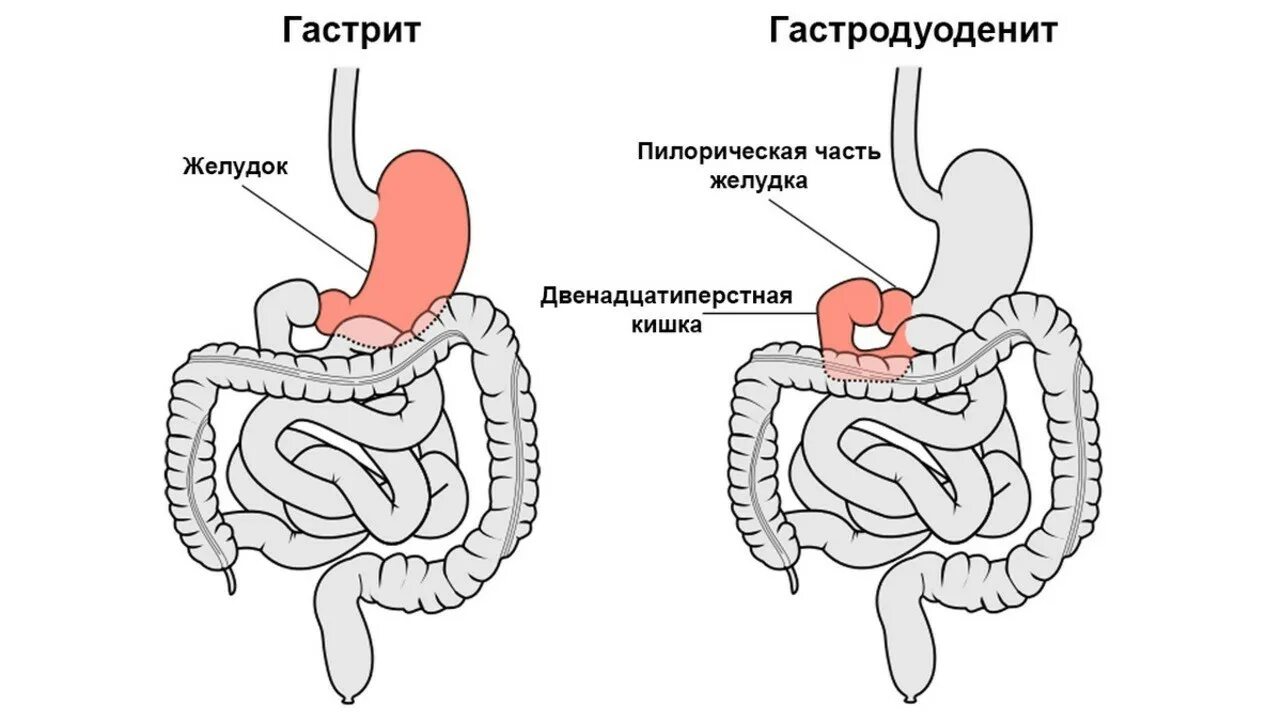 Гастрит лекция. Дуоденит клинические рекомендации. Хронический гастрит дуоденит. Хронический гастрит и гастродуоденит.