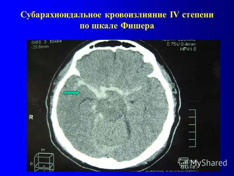 код субарахноидального кровоизлияния