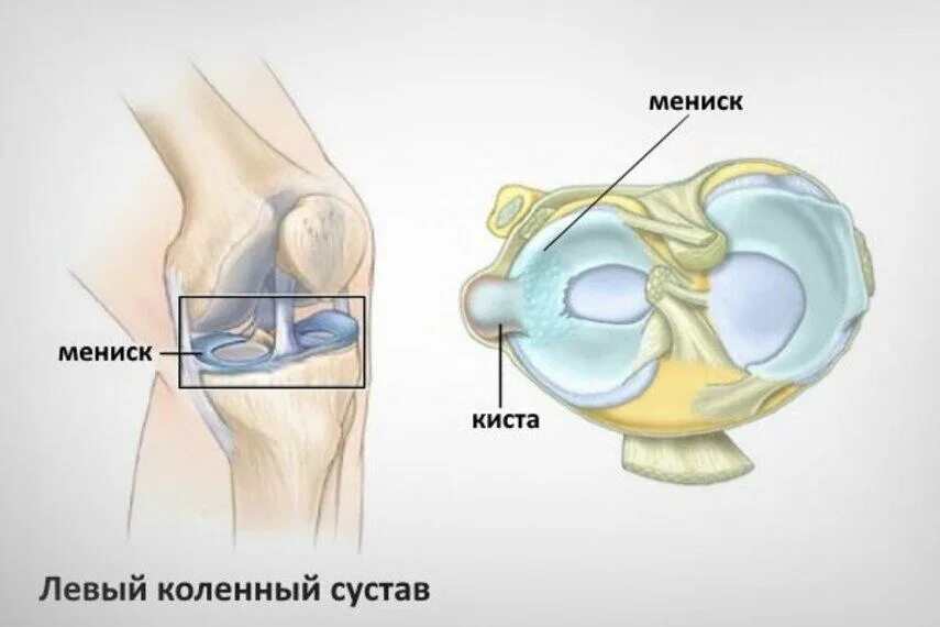 Разрыв мениска коленного сустава как лечить отзывы. Синовиальная киста коленного сустава. разрыв мениска коленного сустава. латеральный мениск коленного сустава разрыв. разрыв заднего рога медиального мениска коленного сустава симптомы.