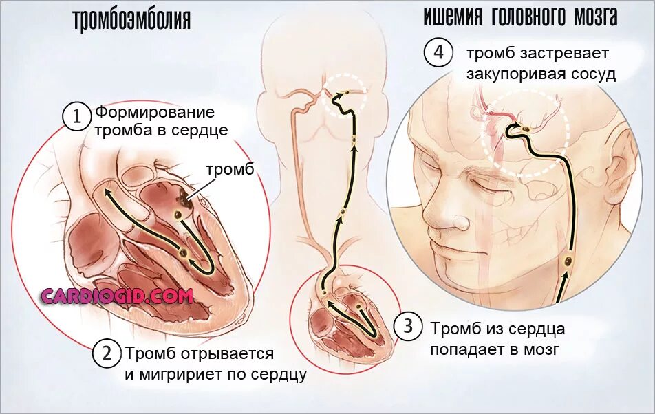 Тромб в сердце оторвался. Тромб сердца тромб в сердце. Сердечный тромбоз