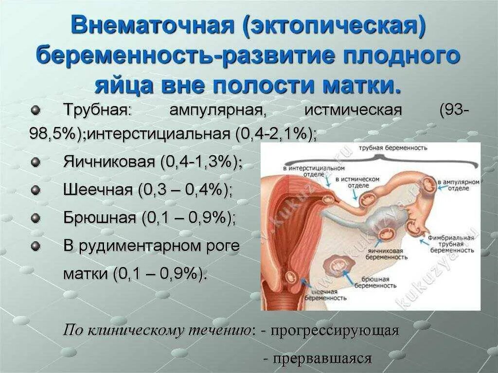 Забеременела при непроходимости труб. Эктопическая Трубная беременность. Внематочная (эктопическая) беременность. Ампулярная Трубная беременность. Внематочная Трубная беременность.