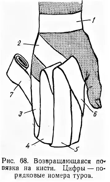 Наложение повязки варежка алгоритм. Наложение возвращающейся повязки на культю. Возвращающаяся повязка на кисть. Технику наложения повязки на культю. Наложение повязки на культю бедра.