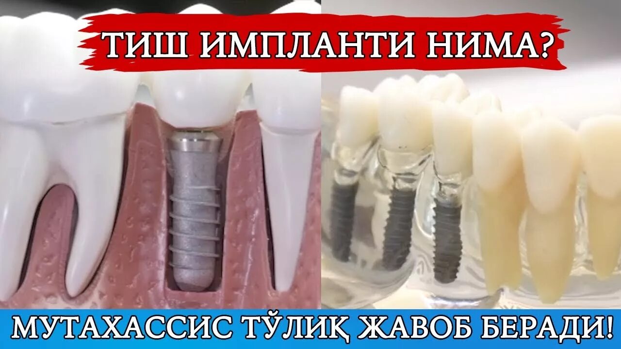 Имплантат тишлар нархи. Тиш.